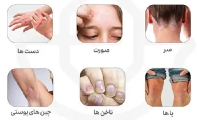 پسوریازیس در سالمندانخانه سالمندان نهران